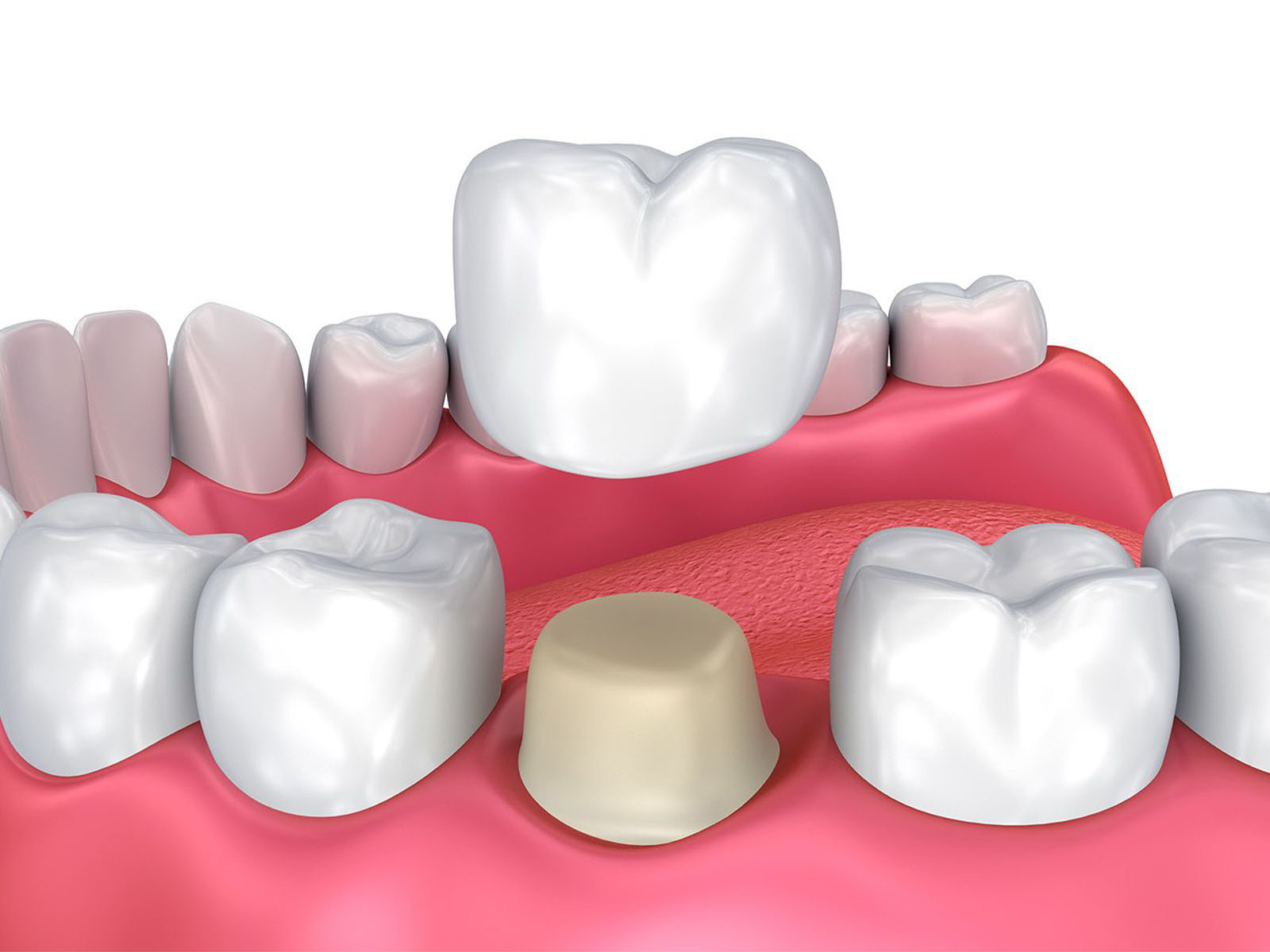 Ceramic Crowns