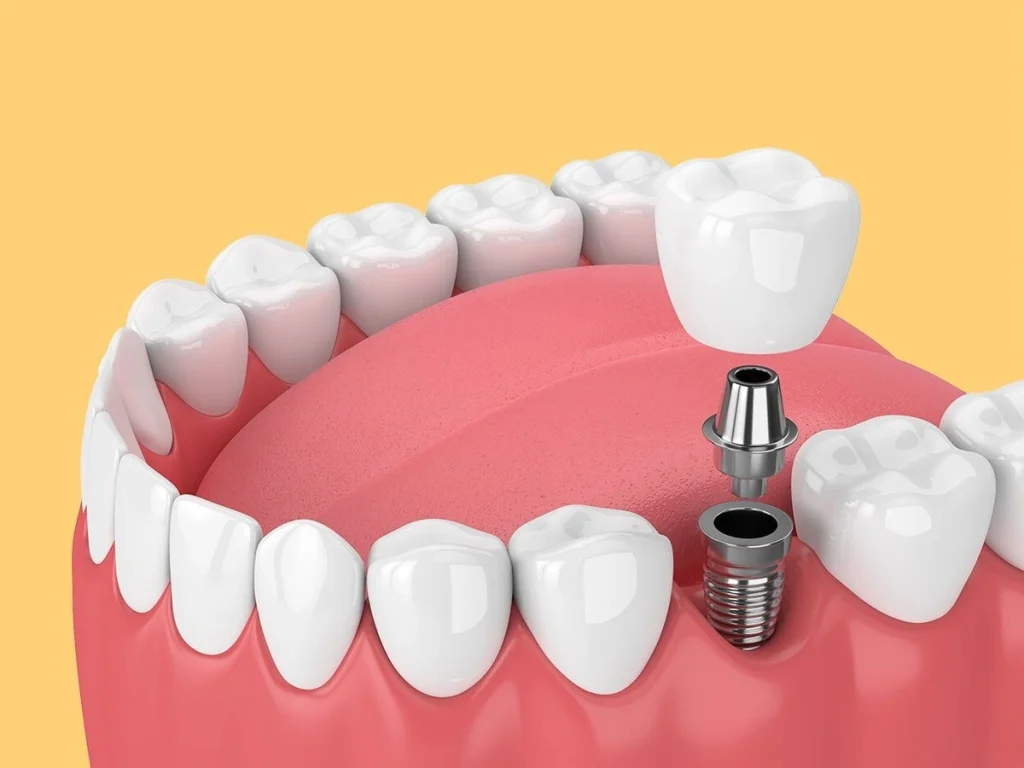 abutment placement