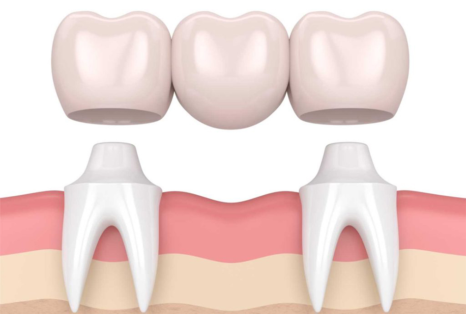 Dental Crowns