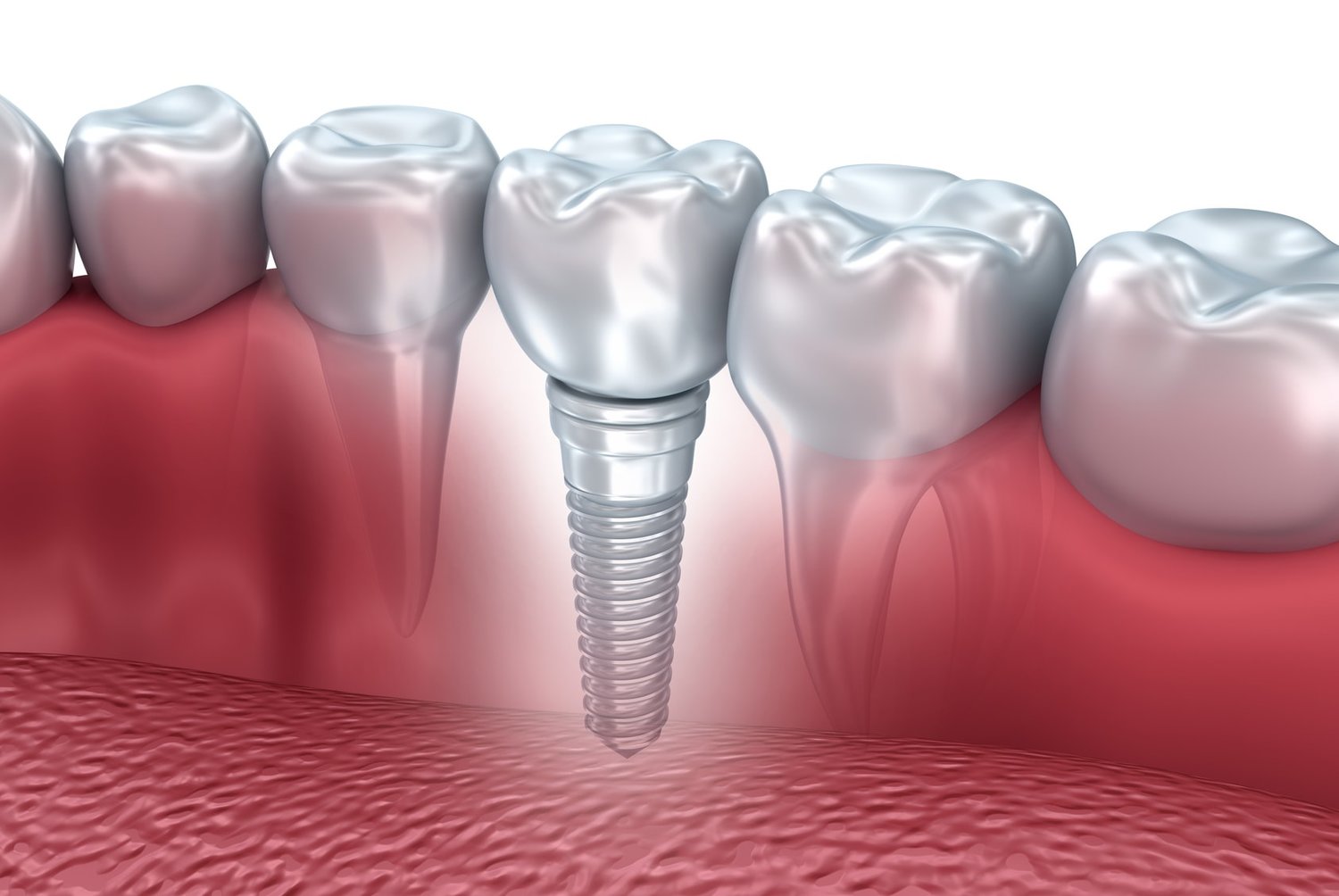 Dental Implants