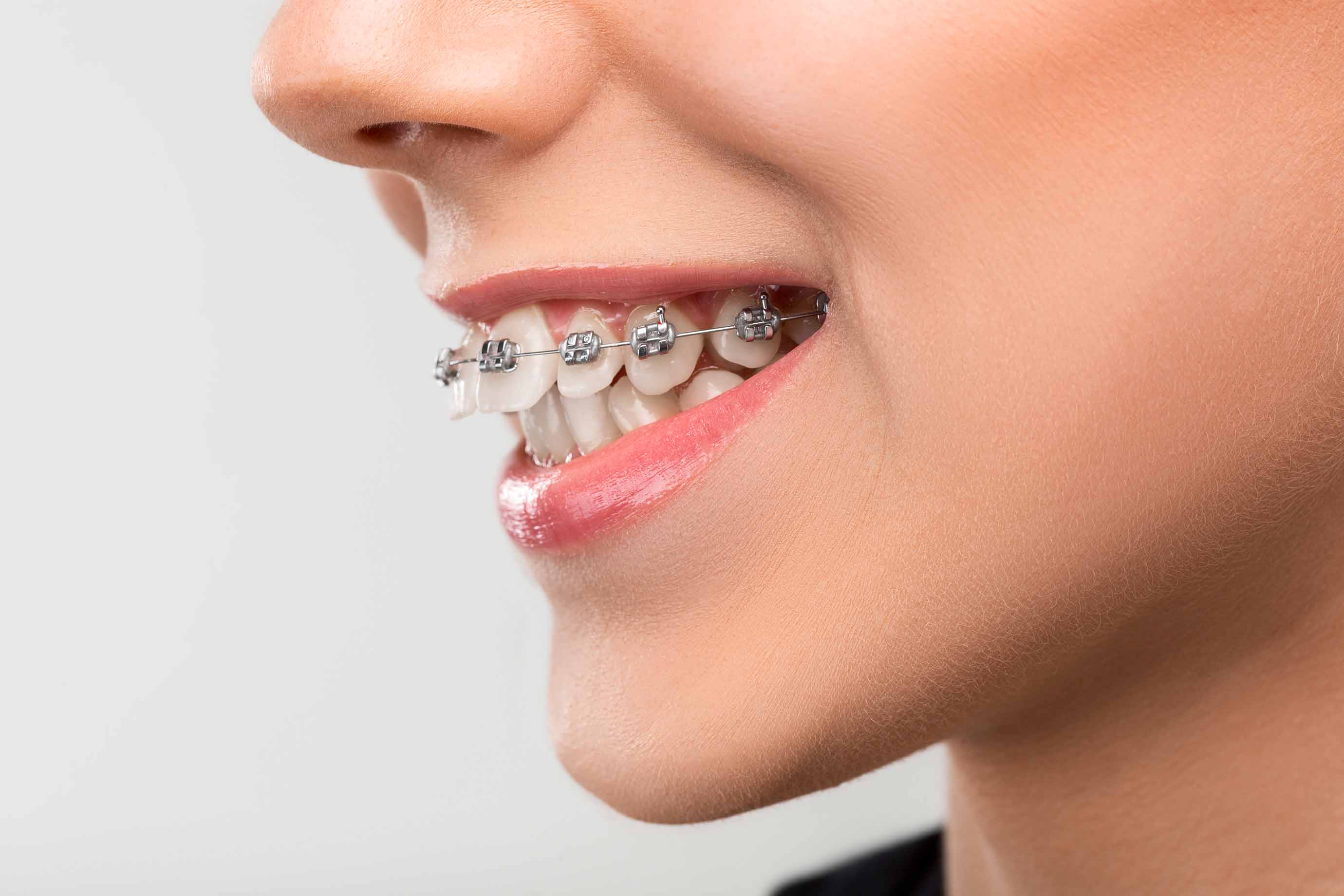 Orthodontic Treatment Options