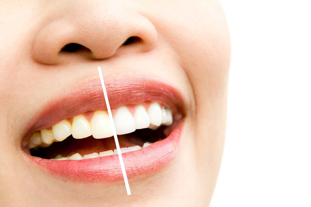 affordable dental veneers